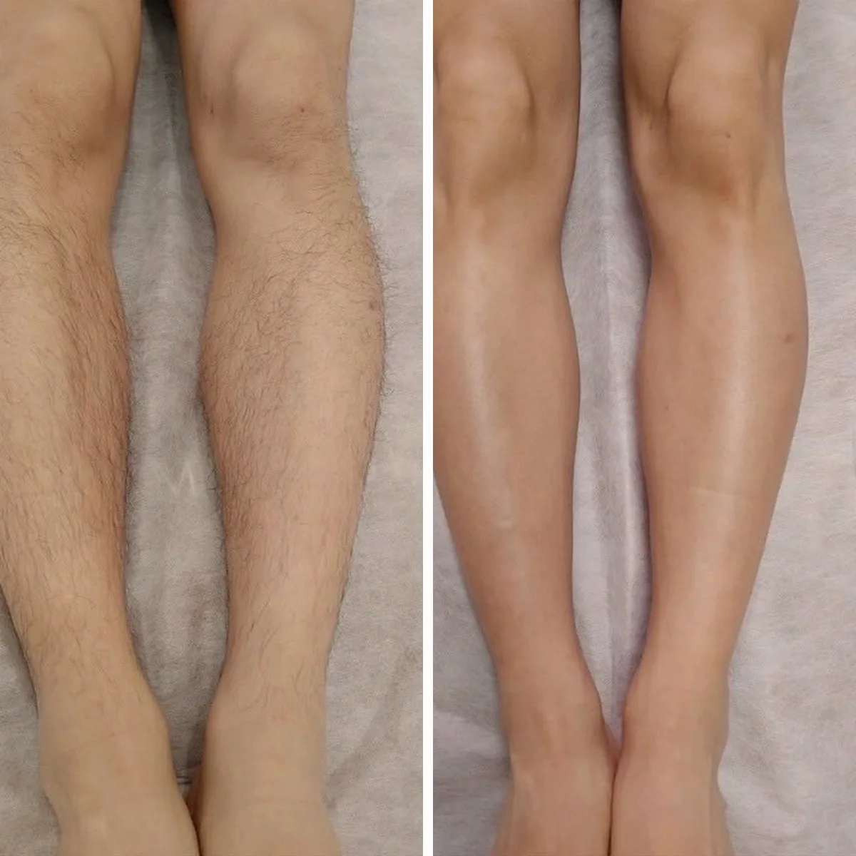 다리 왁싱 전후 비교